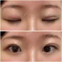 二重埋没 新宿麗美容皮膚科	 DAY 0 サムネイル用