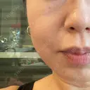 糸リフト BAO CLINIC 梅田院 DAY 10 サムネイル用