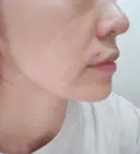 ヒアルロン酸注入（頬） 日比谷公園前歯科医院 DAY 4 サムネイル用