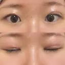 二重埋没 新宿麗美容皮膚科	 DAY 1 サムネイル用