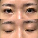 二重埋没 / クマ治療 / 上まぶたの脂肪取り / 下まぶたの脂肪取り NARU Beauty Clinic 【ナルクリ】 DAY 30 サムネイル用