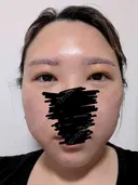 上まぶたたるみ取り / ダーマペン / 毛穴洗浄（ハイドラフェイシャルなど） Leap beauty clinic DAY 4 サムネイル用