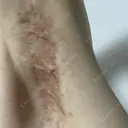 ワキ汗治療（切開） 石倉クリニック 水戸院 DAY 63 サムネイル用