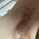 ワキ汗治療（切開） 石倉クリニック 水戸院 DAY 63 サムネイル用