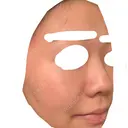 フラクショナルレーザー（毛穴・ニキビ跡） しらゆりメディカルクリニック （旧しらゆりビューティークリニック） AFTER サムネイル用