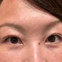 クマ治療 ROOTS Clinic AFTER サムネイル用