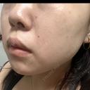 エレクトロポレーション / ルメッカ B-LINE CLINIC 池袋院 AFTER サムネイル用