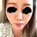 ヒアルロン酸注入（鼻） / ヒアルロン酸注入（あご） / ボトックス（眉間） 共立美容外科 福岡院 AFTER サムネイル用
