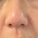 フラクショナルレーザー（毛穴・ニキビ跡） ガーデンクリニック 名古屋院 DAY 1 サムネイル用