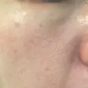 フラクショナルレーザー（毛穴・ニキビ跡） ガーデンクリニック 名古屋院 DAY 1 サムネイル用