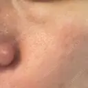 フラクショナルレーザー（毛穴・ニキビ跡） ガーデンクリニック 名古屋院 DAY 1 サムネイル用