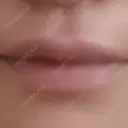 ヒアルロン酸注入（唇） / ボトックス（口角） ルラ美容クリニック 渋谷本院 AFTER サムネイル用