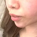 ヒアルロン酸注入（唇） / ボトックス（口角） 東京美容外科 熊本院 DAY 13 サムネイル用