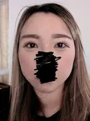 上まぶたたるみ取り / ダーマペン / 毛穴洗浄（ハイドラフェイシャルなど） Leap beauty clinic DAY 6 サムネイル用