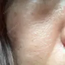 フラクショナルレーザー（毛穴・ニキビ跡） ガーデンクリニック 名古屋院 AFTER サムネイル用