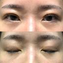 二重埋没 / クマ治療 / 上まぶたの脂肪取り / 下まぶたの脂肪取り NARU Beauty Clinic 【ナルクリ】 DAY 32 サムネイル用