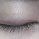 ほくろ・いぼ切除（肌） ガーデンクリニック 船橋院 AFTER サムネイル用