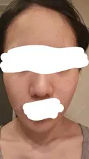 水光注射（ハリ・美肌） RAISE CLINIC 【レイズクリニック】 AFTER サムネイル用