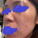 ポテンツァ NARU Beauty Clinic 【ナルクリ】 DAY 15 サムネイル用