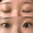 二重埋没 新宿麗美容皮膚科	 DAY 4 サムネイル用