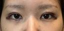 目頭切開 / 自然癒着法 / 眼瞼下垂（非切開） LUHO（ルホ）美容外科 DAY 7 サムネイル用