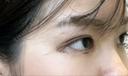 目頭切開 / 自然癒着法 / 眼瞼下垂（非切開） LUHO（ルホ）美容外科 DAY 21 サムネイル用