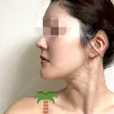 脂肪吸引（顔） 銀座マイアミ美容外科 DAY 217 サムネイル用