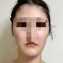 脂肪吸引（顔） 銀座マイアミ美容外科 AFTER サムネイル用