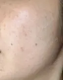 その他（肌） / 光治療（フォトフェイシャルなど） ゆきスキンクリニック 東池袋 AFTER サムネイル用