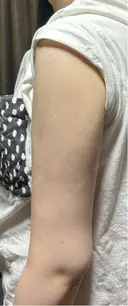 脂肪吸引（二の腕） / 脂肪吸引（肩） 湘南美容クリニック 高崎院 DAY 60 サムネイル用