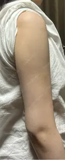 脂肪吸引（二の腕） / 脂肪吸引（肩） 湘南美容クリニック 高崎院 DAY 60 サムネイル用
