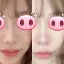 スレッドノーズ / 鼻中隔延長（非切開） ASTRA BEAUTY CLINIC DAY 0 サムネイル用