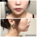 ボトックス（あご） / ヒアルロン酸注入（あご） ルラ美容クリニック 町田院 DAY 21 サムネイル用