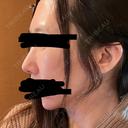 鼻尖形成（切開） / 軟骨移植 / 鼻柱下降・鼻唇角形成（猫手術） eクリニック 金沢本院 DAY 11 サムネイル用