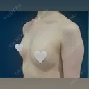 豊胸（脂肪注入） S.T styleクリニック DAY 107 サムネイル用