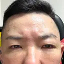 下まぶたたるみ取り / 下まぶたの脂肪取り / 脂肪注入（目の下） 湘南美容クリニック 千葉センシティ院 DAY 7 サムネイル用