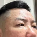 下まぶたたるみ取り / 下まぶたの脂肪取り / 脂肪注入（目の下） 湘南美容クリニック 千葉センシティ院 DAY 7 サムネイル用