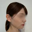 糸リフト / 脂肪吸引（顔） / ジョールファット除去 / 脂肪吸引注射（顔） / ヒアルロン酸注入（あご） SEA CLINIC（シークリニック） DAY 99 サムネイル用