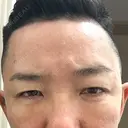 下まぶたたるみ取り / 下まぶたの脂肪取り / 脂肪注入（目の下） 湘南美容クリニック 千葉センシティ院 DAY 8 サムネイル用
