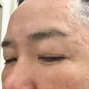 下まぶたたるみ取り / 下まぶたの脂肪取り / 脂肪注入（目の下） 湘南美容クリニック 千葉センシティ院 DAY 8 サムネイル用