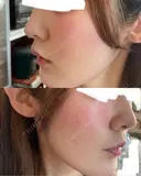 ボトックス（エラ・小顔） / ダーマペン ルラ美容クリニック 静岡院 DAY 3 サムネイル用