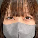 目頭切開 ネビュラクリニック 京都院 DAY 7 サムネイル用