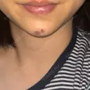 ヒアルロン酸注入（あご） ヴェリテクリニック 大阪院 DAY 3 サムネイル用