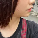 ヒアルロン酸注入（あご） ヴェリテクリニック 大阪院 DAY 2 サムネイル用