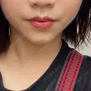 ヒアルロン酸注入（あご） ヴェリテクリニック 大阪院 DAY 2 サムネイル用