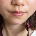 ヒアルロン酸注入（あご） ヴェリテクリニック 大阪院 DAY 1 サムネイル用