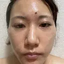 ボトックス（エラ・小顔） TCB東京中央美容外科 川口院 DAY 3 サムネイル用