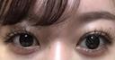 自然癒着法 / 眼瞼下垂（非切開） LUHO（ルホ）美容外科 DAY 33 サムネイル用