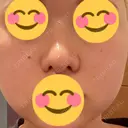 鼻尖形成（切開） / 小鼻縮小（切開） / 軟骨移植 湘南美容クリニック 名古屋栄院 DAY 37 サムネイル用