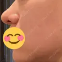 鼻尖形成（切開） / 小鼻縮小（切開） / 軟骨移植 湘南美容クリニック 名古屋栄院 DAY 37 サムネイル用
